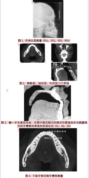 不同垂直骨面型骨性iii类患者舌体位置与下前牙 牙槽骨厚度相关性的