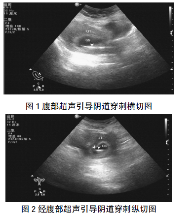 腹部超声引导阴道穿刺横切图