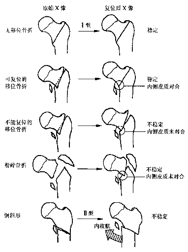 股骨颈缩短-诊断为股骨转子间骨折回